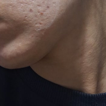 Korendy Anua Azelaic 10 Hyaluron Serumu Cildimde Şiddetli Hassasiyet Yarattı Ve İade Talep Ediyorum