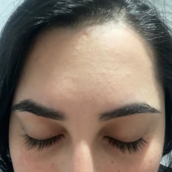 Newgen Yüz Serumu Şiddetli Yan Etkiler Ve Açıklama Talebi
