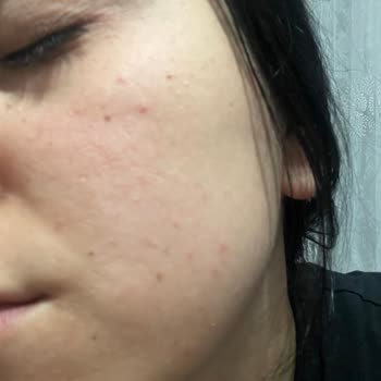 Newgen Yüz Serumu Şiddetli Yan Etkiler Ve Açıklama Talebi