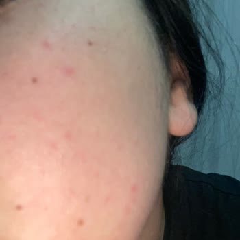 Newgen Yüz Serumu Şiddetli Yan Etkiler Ve Açıklama Talebi