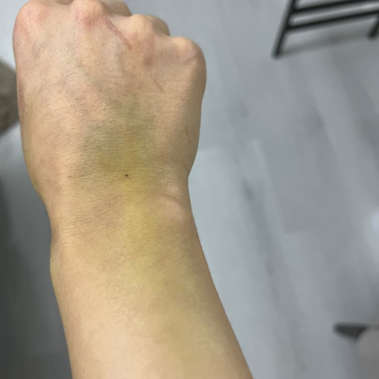 HGS Çekimi Sırasında Yanlış Damar Yolu Açılması Kolumda Şiddetli Morarma Ve Şişlik