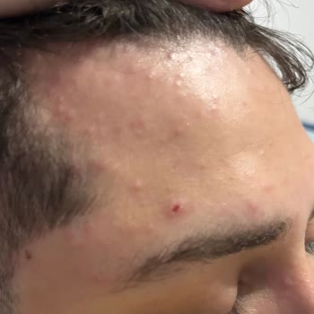 Acil Serviste Yanlış Antibiyotik Reçetesi Eşimin Sağlığını Tehlikeye Atıyor