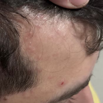 Acil Serviste Yanlış Antibiyotik Reçetesi Eşimin Sağlığını Tehlikeye Atıyor