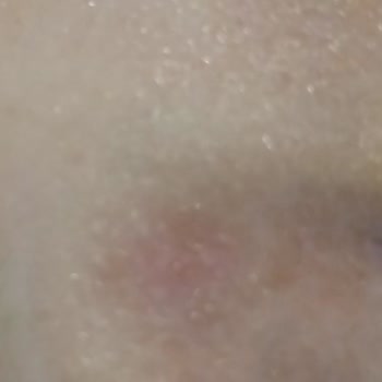 Expigment Kremi Yan Etki Sonucu Yüzümde Morumsu Lekeler