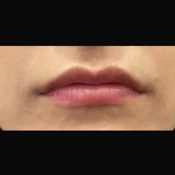 Kadıköy Klinik Dudak Dolgu İşleminde Yarım CC Dolgu Ve Tam Ücret Talebi