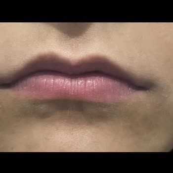 Kadıköy Klinik Dudak Dolgu İşleminde Yarım CC Dolgu Ve Tam Ücret Talebi