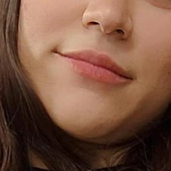 Maya Estetik Esentepe’de Dudak Dolgusu Sonrası Asimetri Ve İlgisiz Hizmet Şikayeti