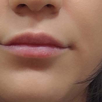 Maya Estetik Esentepe’de Dudak Dolgusu Sonrası Asimetri Ve İlgisiz Hizmet Şikayeti