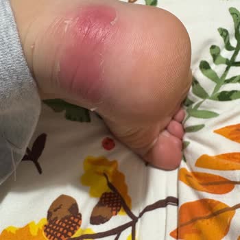 Çocuğumun Ayağını Yara Veren Ayakkabı Ve Şirketin İlgisiz Açıklaması