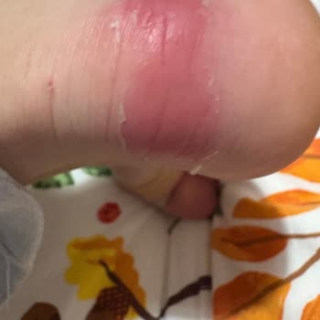 Çocuğumun Ayağını Yara Veren Ayakkabı Ve Şirketin İlgisiz Açıklaması