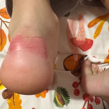 Çocuğumun Ayağını Yara Veren Ayakkabı Ve Şirketin İlgisiz Açıklaması