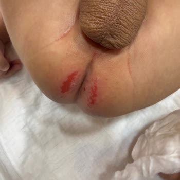 Prima Premium Care Bebek Bezinde Şiddetli Pişik Sorunu Ve İade Talebi