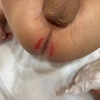 Prima Premium Care Bebek Bezinde Şiddetli Pişik Sorunu Ve İade Talebi