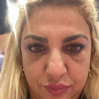 Göz Kapak Ameliyatı Sonrası Kötüleşen Görünüm Ve Hastanenin Cevapsızlığı