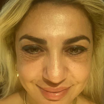 Göz Kapak Ameliyatı Sonrası Kötüleşen Görünüm Ve Hastanenin Cevapsızlığı