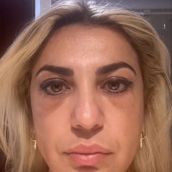 Göz Kapak Ameliyatı Sonrası Kötüleşen Görünüm Ve Hastanenin Cevapsızlığı
