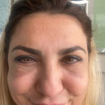 Göz Kapak Ameliyatı Sonrası Kötüleşen Görünüm Ve Hastanenin Cevapsızlığı