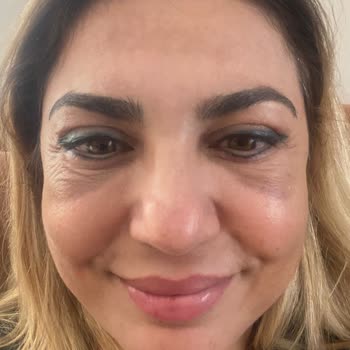 Göz Kapak Ameliyatı Sonrası Kötüleşen Görünüm Ve Hastanenin Cevapsızlığı