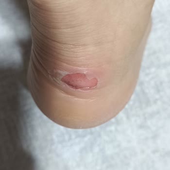 Ayak Yaralayan Botta İade Ve Değişim Talebim Reddedildi