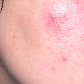 Cerave Temizleme Jelinde Cilt Yanığı Ve Sivilce Patlaması