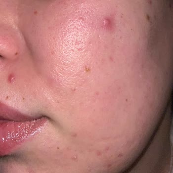 Cerave Temizleme Jelinde Cilt Yanığı Ve Sivilce Patlaması