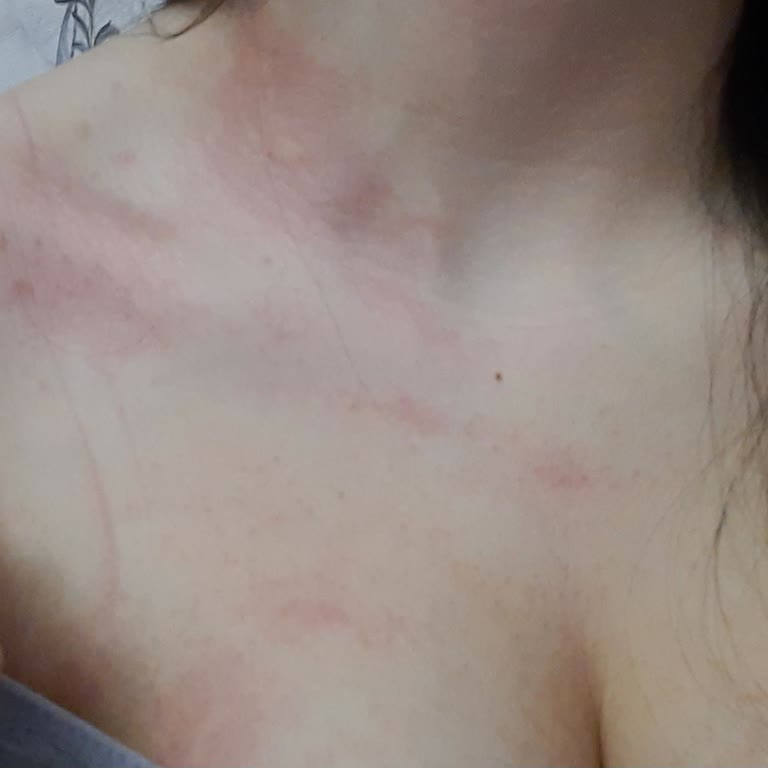 Penti Wowbra Sütyeninde Şiddetli Kaşıntı Ve Kızarıklık, Değişim Talebi