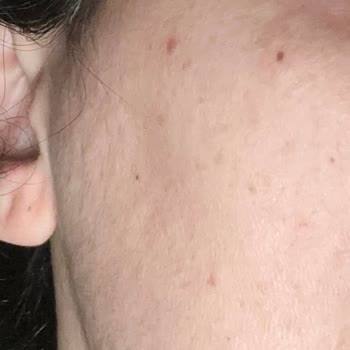 Cilt Reaksiyonu Nedeniyle PH Lab Maskeye İade Ve Sağlık Açısından Ücret İadesi Talebi