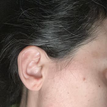 Cilt Reaksiyonu Nedeniyle PH Lab Maskeye İade Ve Sağlık Açısından Ücret İadesi Talebi