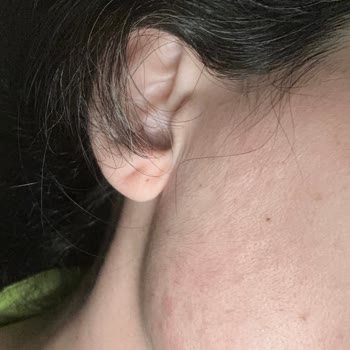 Cilt Reaksiyonu Nedeniyle PH Lab Maskeye İade Ve Sağlık Açısından Ücret İadesi Talebi