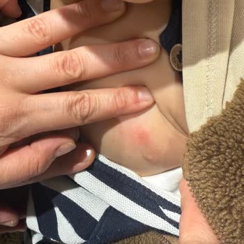 OMO Sıvı Active Deterjanının Çocuğumda Alerjik Reaksiyonlara Neden Olması