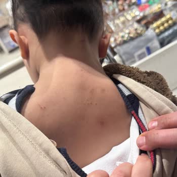 OMO Sıvı Active Deterjanının Çocuğumda Alerjik Reaksiyonlara Neden Olması