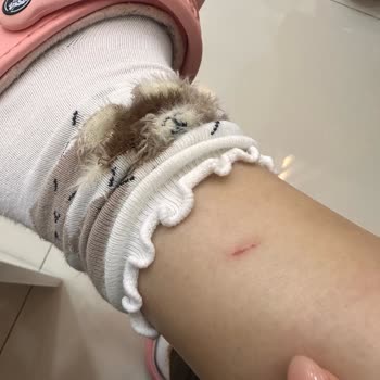 Üretim Hatası Nedeniyle Kesilen Bilek Ve Geri Dönüş Yapılmayan Aldo Botta İade Talebi