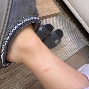 Üretim Hatası Nedeniyle Kesilen Bilek Ve Geri Dönüş Yapılmayan Aldo Botta İade Talebi