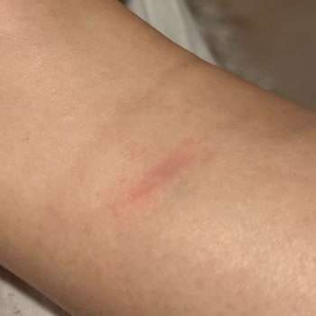 Üretim Hatası Nedeniyle Kesilen Bilek Ve Geri Dönüş Yapılmayan Aldo Botta İade Talebi