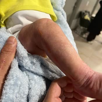 Yüzyıl Pendik Hastanesi Acil Serviste Çocuğun Ayağı Kesildi Ve Personel İhmali Vardı