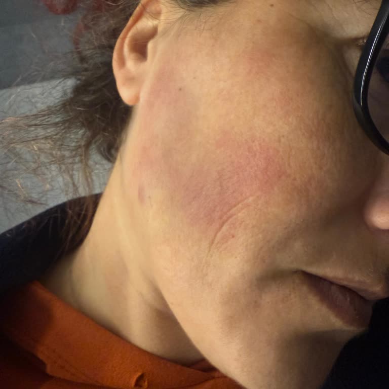 Neutrogena Yüz Temizleme Jelinde Şiddetli Alerjik Reaksiyon Ve Yanma Şikayeti