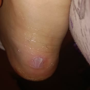 Bench Bilek Botta Ayağa Vurulan Tasarım Hatası Ve Garanti Reddi