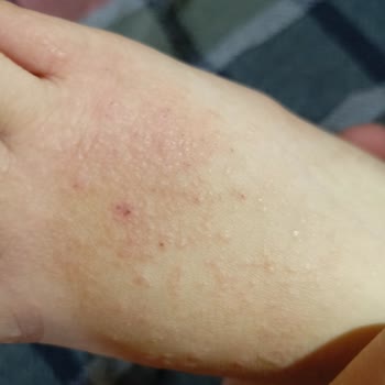 FLO Ayakkabısının Çocuğumun Ayağında Egzama Oluşturması, Maddi Ve Manevi Zarar