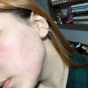 Yanıklar Ve Personel Değişikliği Nedeniyle Epilasyon Hizmetinde Mağduriyet