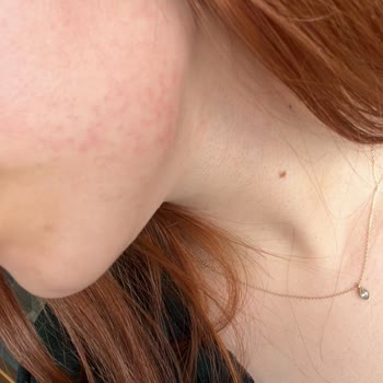 Yanıklar Ve Personel Değişikliği Nedeniyle Epilasyon Hizmetinde Mağduriyet