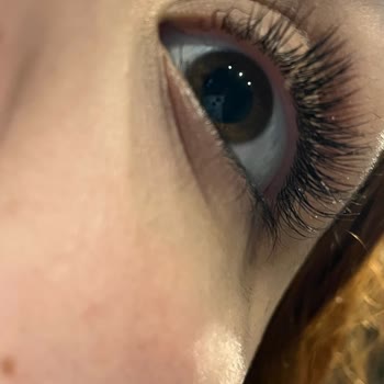 Yanıklar Ve Personel Değişikliği Nedeniyle Epilasyon Hizmetinde Mağduriyet