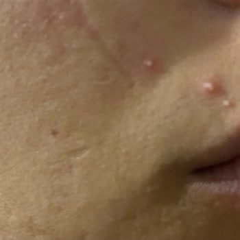 Alerjik Reaksiyonlu Fondöten İçin İade Reddi Ve Mağduriyet