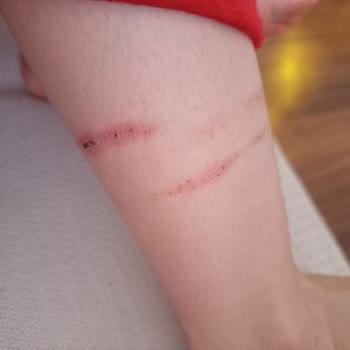 Ayak Bileklerimizde Yara Oluşturan Botlar İçin Ücret İadesi Talebi