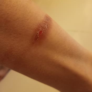 Ayak Bileklerimizde Yara Oluşturan Botlar İçin Ücret İadesi Talebi