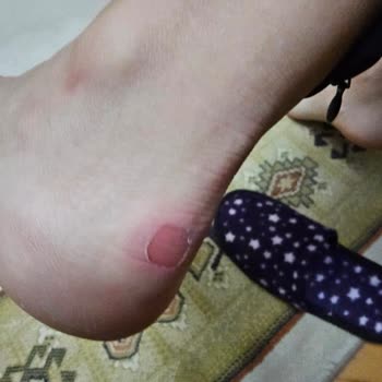 Sağlıksız Bot Ve Tüketici Hakları İhlali: İlk Kullanımda Ayağımı Yaran Ürün