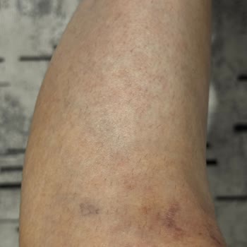 Lazer Epilasyonda Söz Verilen %80 Sonuç Gerçekleşmedi Ve Randevu Kaosu