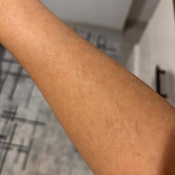 Lazer Epilasyonda Söz Verilen %80 Sonuç Gerçekleşmedi Ve Randevu Kaosu