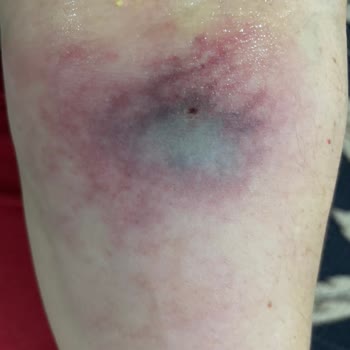 Avicenna Ataşehir Hastanesi'nde Yanlış Damar Yolu Uygulaması Ve İhmalkar Müdahale