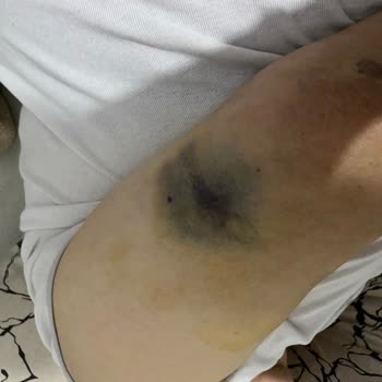 Atlas Hastanesi Kalp Krizi Şüphesiyle Giriş Yapan Hastanın Yoğun Bakım Hataları