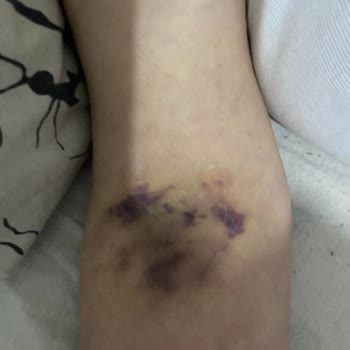 Atlas Hastanesi Kalp Krizi Şüphesiyle Giriş Yapan Hastanın Yoğun Bakım Hataları